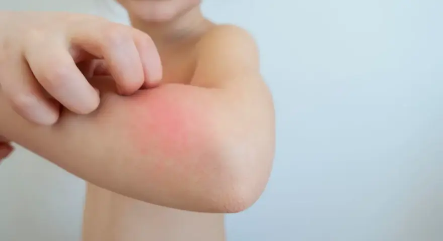 Kind kratzt sich am roten, geschwollenen Arm. Tipps, wie man Schnakenstiche behandeln kann, sind hier wichtig.