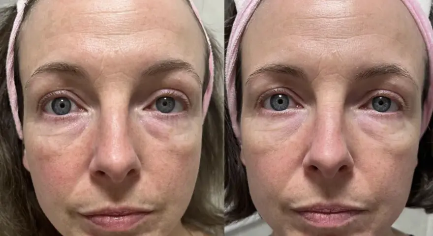 Confronto viso: pelle con niacinamide prima e dopo. Miglioramento di rossori e texture.