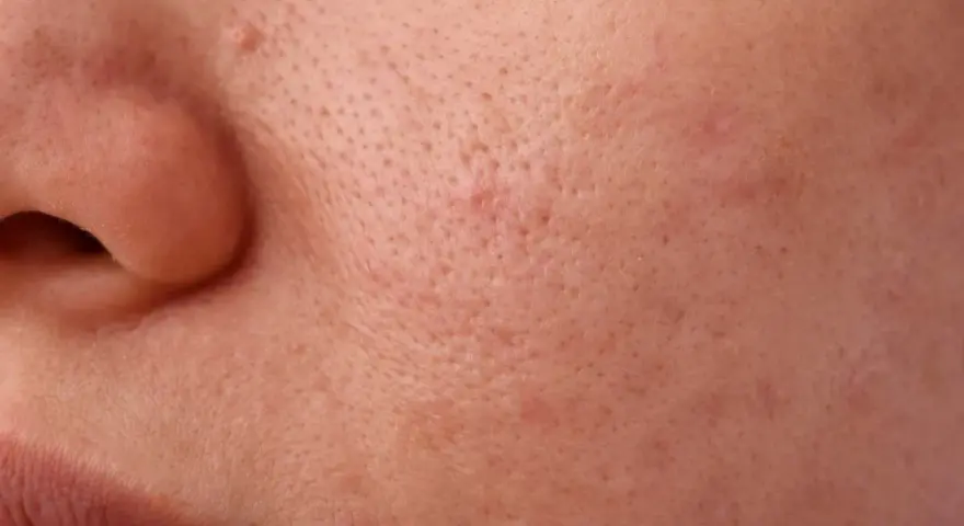 Primo piano della pelle con pori dilatati e alcuni punti neri visibili, che creano una texture irregolare.