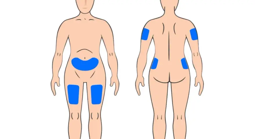 Körperstellen für Injektionen: Bauch, Oberschenkel, Oberarme und Gesäß. So kann man weit spritzen.