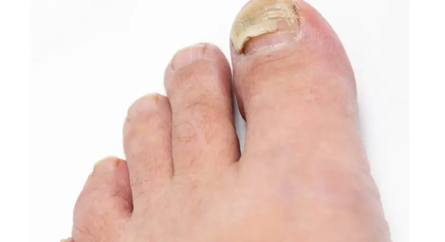 Gros plan sur un pied, montrant un ongle qui se décolle, jauni et épaissi, signe d'une mycose.