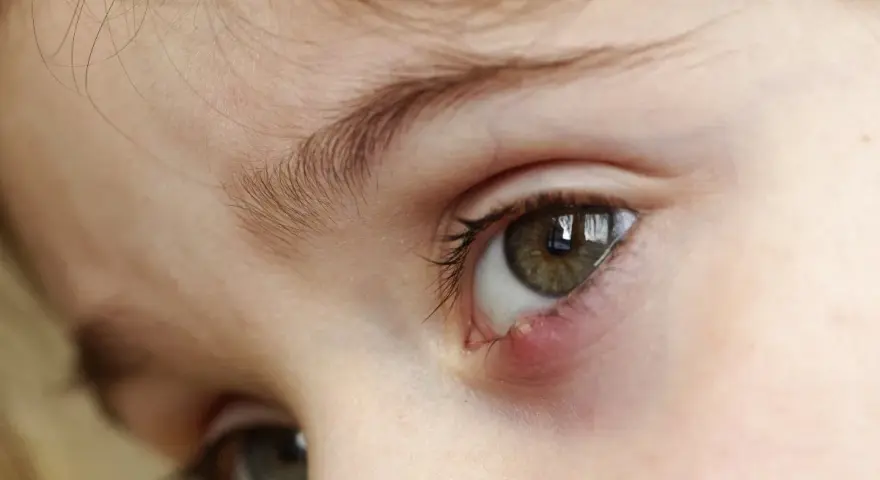 Occhio di bambino con un orzaiolo, segno di stress o stanchezza.