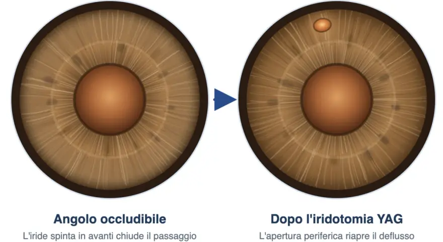 Iridotomia YAG: prima occlusione dell'angolo, dopo apertura per riaprire il deflusso. Valutare i rischi.
