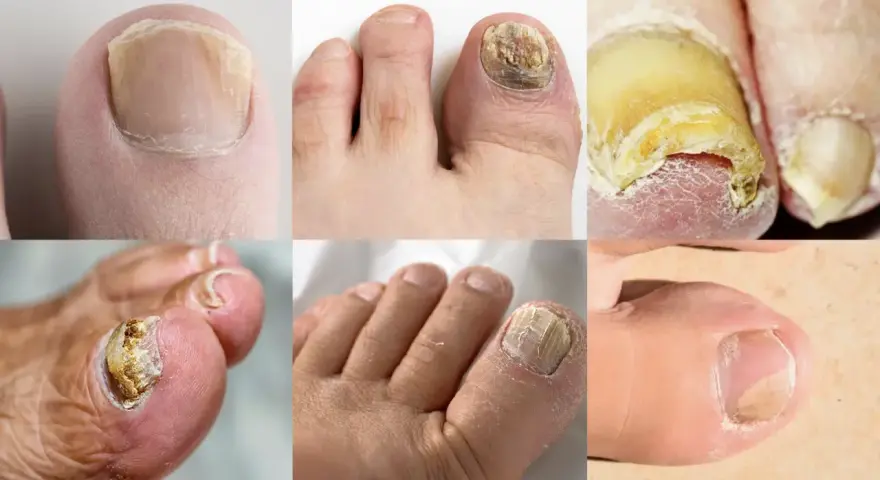 Gros plans de plusieurs orteils montrant différents stades de mycose de l'ongle, avec des ongles jaunis, épaissis et déformés.