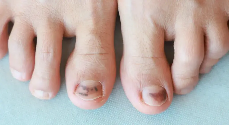 Gros plan sur des orteils, dont deux présentent un hématome sous l'ongle. La durée et la douleur de cet hématome sont visibles.