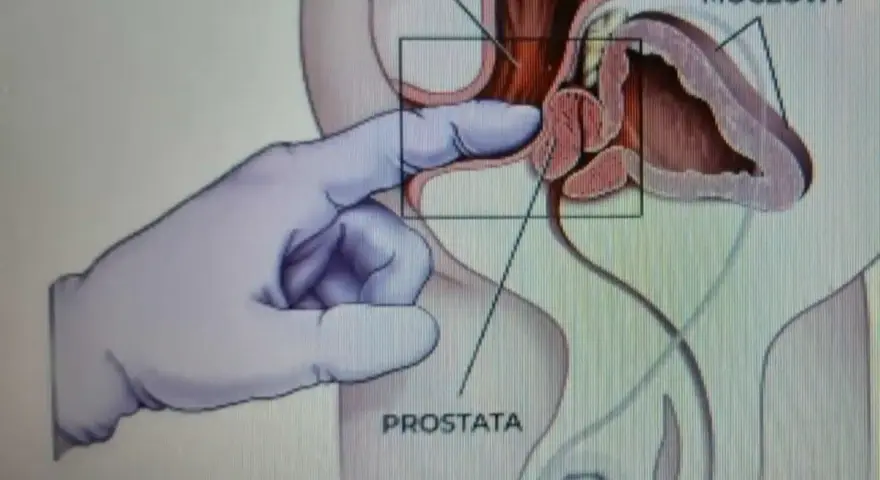 Ilustracja medyczna przedstawiająca palec w rękawiczce wykonujący masaż prostaty przez odbytnicę.