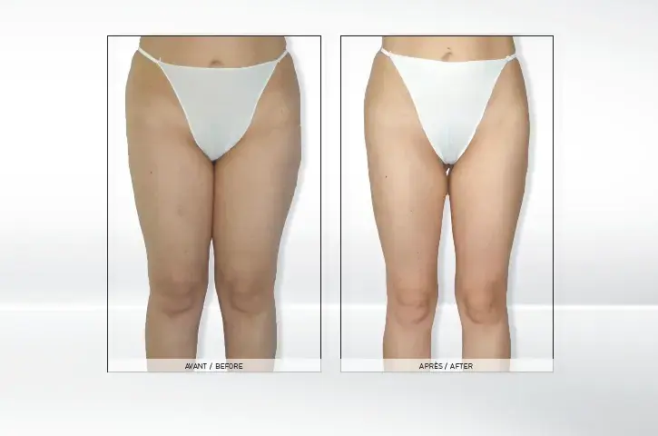 Endermologia: Co to jest? Skuteczny zabieg na cellulit i sylwetkę