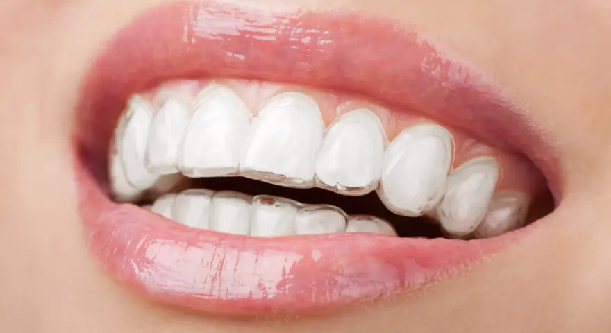 Zbliżenie na usta z błyszczącym błyszczykiem i widocznymi przezroczystymi nakładkami, które korygują zgryz. To dyskretny aparat Invisalign.