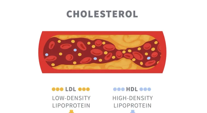 Niski cholesterol LDL sprzyja miażdżycy, tworząc złogi w naczyniach. Wysoki HDL chroni.
