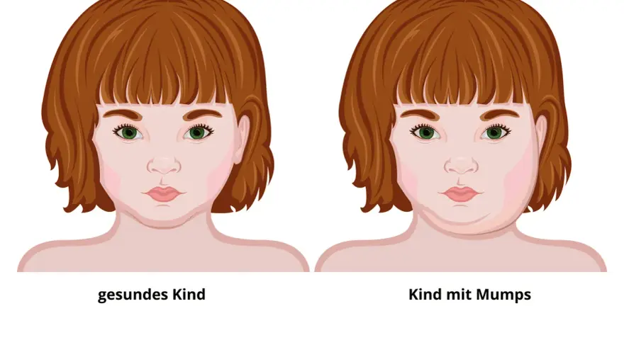 Mumps-Symptome: Erkennen, Verlauf & Komplikationen | Was tun?
