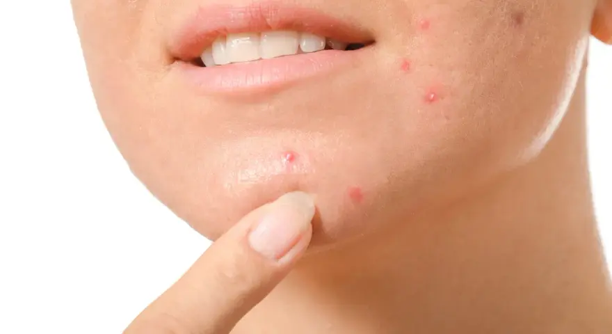 Primo piano del viso di una persona con evidenti segni di acne cistica sul mento e sulla guancia, con un dito che indica una lesione.