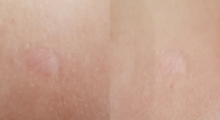 Jasna skóra z widocznymi, lekko zaróżowionymi bliznami po depilacji laserowej.