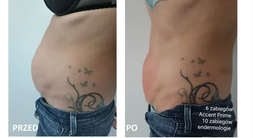 Przed i po zabiegu Accent Prime. Widoczna redukcja tkanki tłuszczowej brzucha, co pokazuje skuteczność liposukcji kawitacyjnej.
