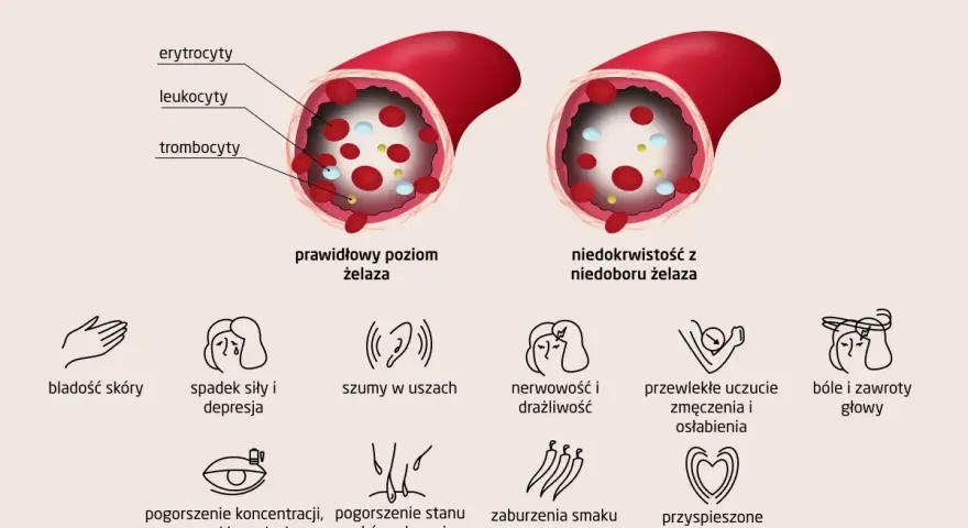 Prawidłowy poziom żelaza w naczyniu krwionośnym vs. niedobór żelaza. Objawy anemii: bladość, zmęczenie, szumy w uszach, bóle głowy.