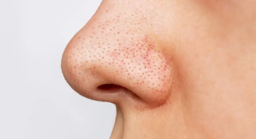 Gros plan sur un nez avec de nombreux points noirs visibles.