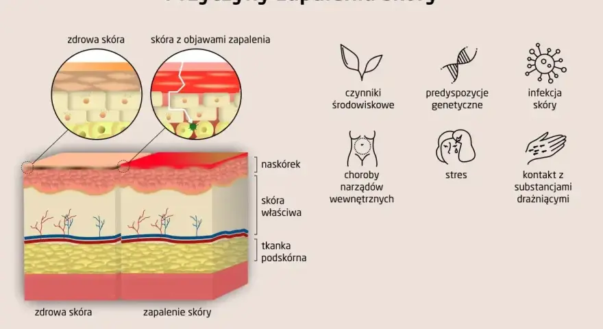 Ilustracja porównująca zdrową skórę i skórę z zapaleniem, z ikonami przedstawiającymi przyczyny AZS.