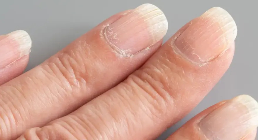 Gros plan sur des doigts montrant des ongles striés verticalement. La signification de ces ongles striés peut varier.