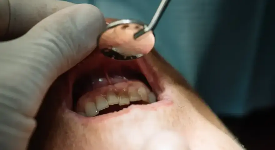 Usta pacjenta z widocznym zaczerwienieniem i obrzękiem dziąseł, wskazującym na nieleczony ropień zęba. Dentysta bada jamę ustną lusterkiem.