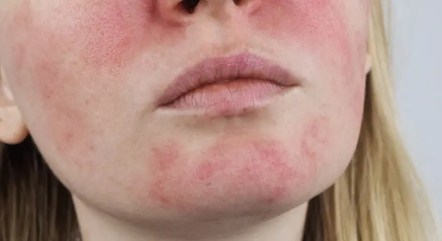Schuppige & gerötete Haut: Ist es Rosacea? Ursachen & Lösungen
