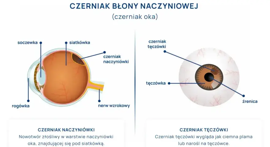 Schemat oka z zaznaczonym czerniakiem naczyniówki i czerniakiem tęczówki. Czerniak oka to poważna choroba.