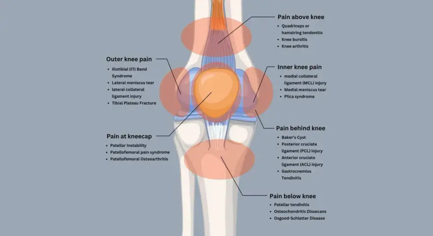 Diagram showing knee pain locations and causes. Excessive spinning can be bad for your knees, leading to issues like IT band syndrome or meniscus tears.