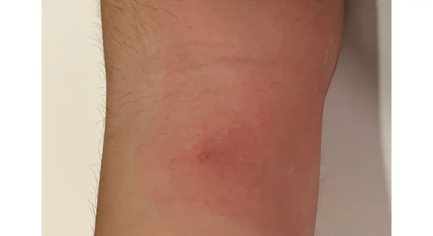 Piel enrojecida con una pequeña protuberancia, indicativa de picaduras chinches de cama como eliminarlas.
