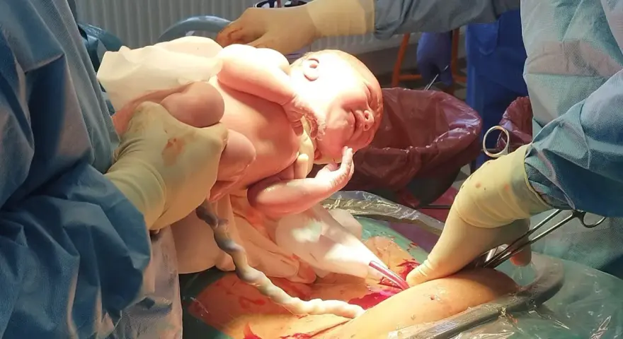 Noworodek wychodzi z brzucha mamy, ręce lekarzy pomagają w porodzie, który był w położeniu miednicowym.