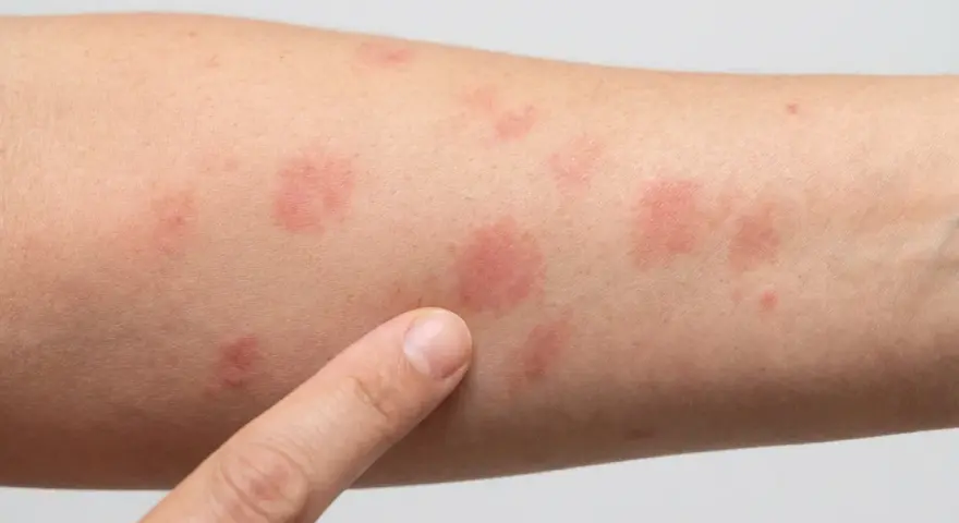 Nahaufnahme eines Arms mit mehreren roten Stellen auf der Haut, die auf einen Ausschlag oder eine allergische Reaktion hindeuten.