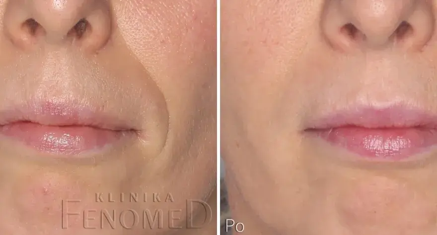 1 ml kwasu hialuronowego: Co naprawdę zmieni w Twojej twarzy?