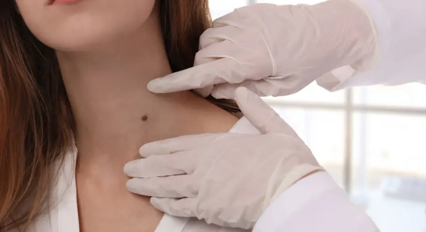 Lekarz w rękawiczkach bada pieprzyk na szyi pacjentki.