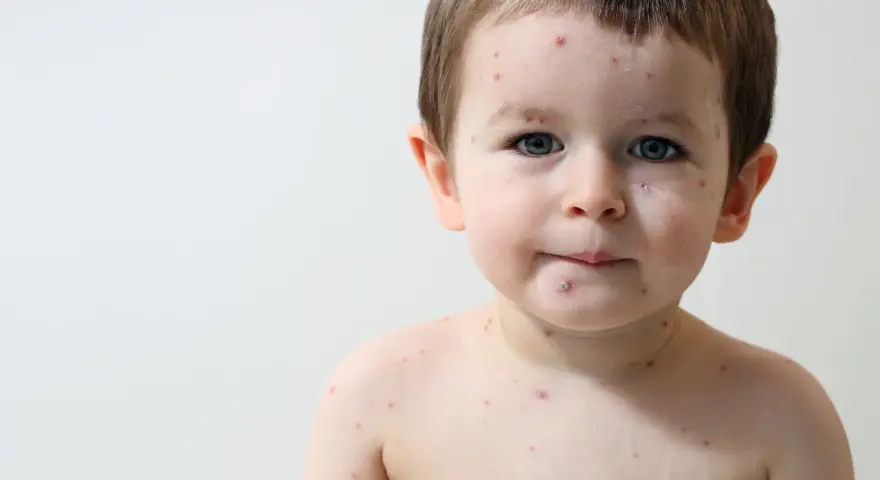 Bambino con puntini rossi sul viso e sul corpo, forse la varicella.