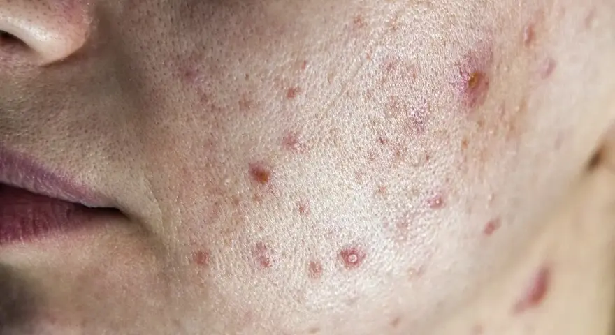 Primo piano della pelle con acne, inclusi diversi brufoli cistici e rossori.