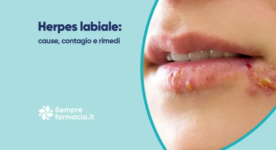 Herpes labiale: cause, contagio e rimedi. Scopri come curare l'herpes labiale e alleviare i sintomi.