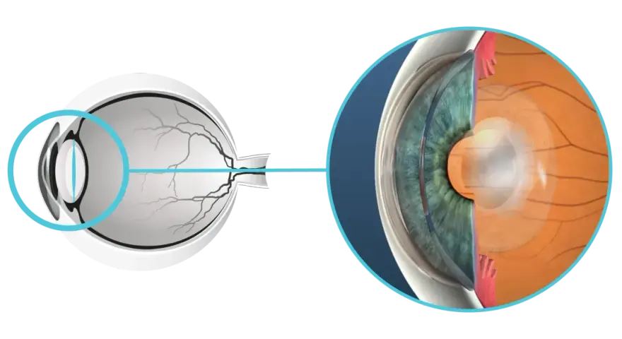 Sezione dell'occhio che mostra la lente e la retina. Si notano aloni dopo capsulotomia, un effetto visivo comune.