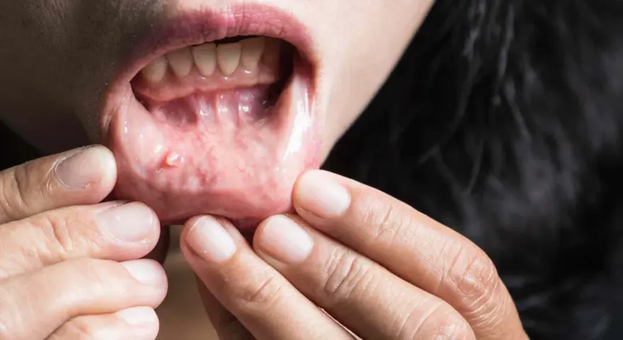 Una persona se revisa la boca, mostrando unos pequeños granos en los labios internos.