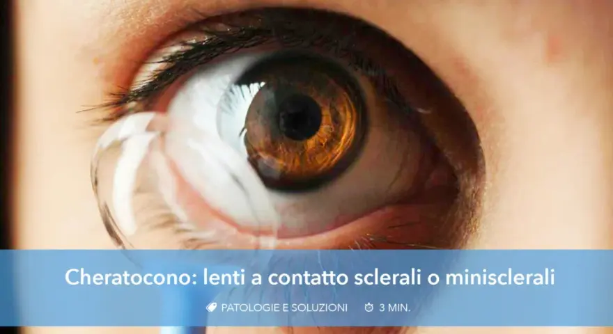 Occhio con cheratocono e lente a contatto applicata. Soluzioni per la visione con cheratocono.