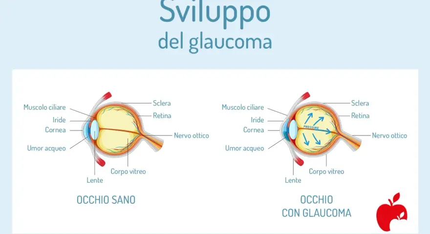 Confronto tra occhio sano e occhio con glaucoma, illustrando l'aumento di pressione. Il termine "abbigliamento significato" non si applica qui.