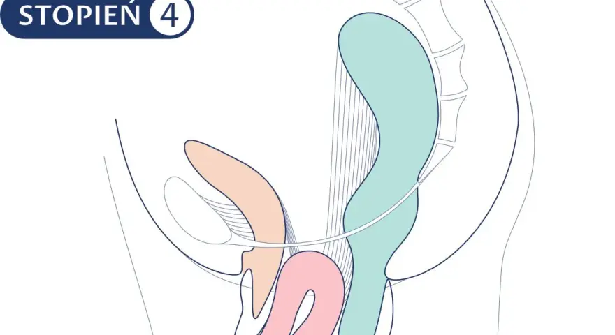Schemat przedstawia zaawansowany etap wypadania macicy (stopień 4). Ilustracja pomaga zrozumieć proces rekonwalescencji po operacji.