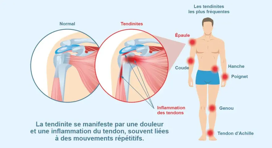 Illustration montrant une tendinite à l'épaule, une inflammation des tendons. L'ibuprofène peut aider à soulager ces douleurs.