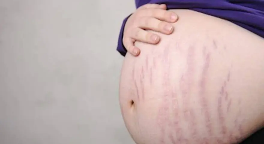 Brzuch z widocznymi rozstępami po ciąży, ślady po nowym życiu.