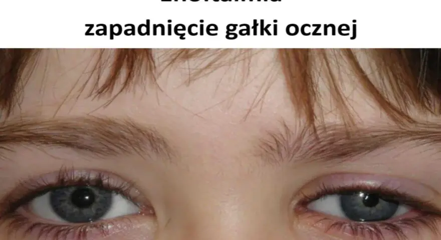 Widoczne zapadnięte oczodoły, objaw enoftalmii.