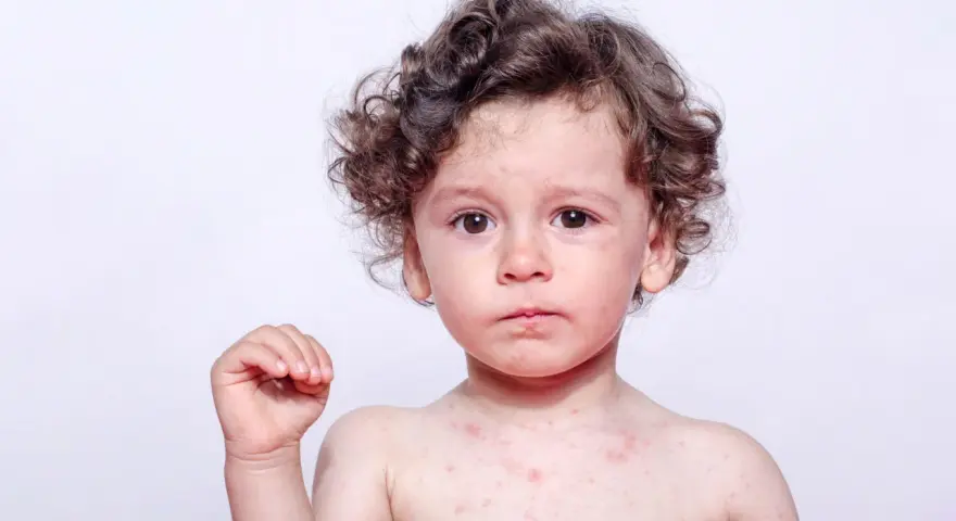 Szkarlatyna: Powrót do przedszkola? 24h po antybiotyku i decyzja lekarza