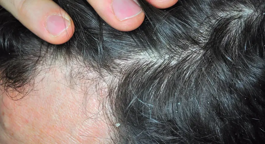 Dedos separando cabello oscuro con caspa blanca. ¿Cómo aliviar el picor de cabeza por estrés?