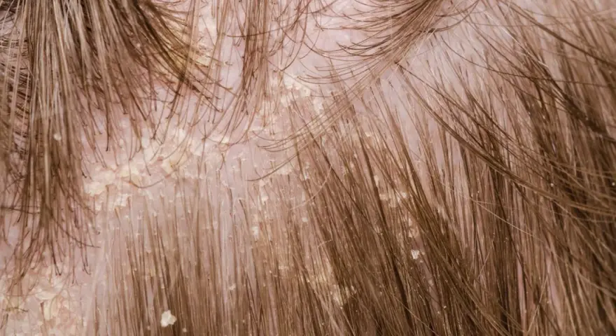 Nahaufnahme der Kopfhaut mit sichtbaren gelblichen Krusten und Schuppen, die sich zwischen den braunen Haaren abzeichnen.