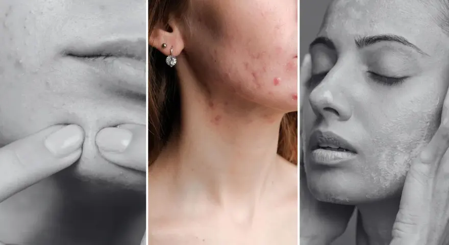 Trzy panele pokazujące problemy skórne: wyciskanie pryszcza, trądzik na twarzy i szyi, oraz pielęgnacja skóry. Dermatologia i wenerologia w praktyce.