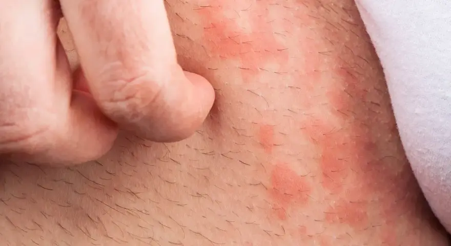 Haut mit roten Flecken und Haaren, die von einem Finger gekratzt werden. Backpulver gegen Juckreiz könnte Linderung verschaffen.
