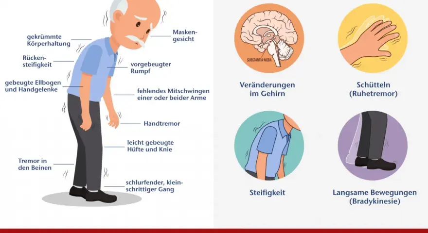 Illustration von Parkinson-Symptomen: gebeugte Haltung, Tremor, Steifigkeit, Gehirn.