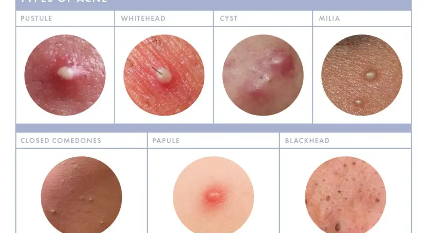 Close-up images show various types of acne, including pustules, whiteheads, cysts, milia, closed comedones, papules, and blackheads. Some show small white bumps on the face.