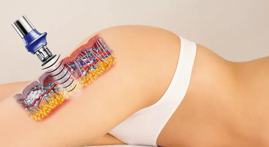 Urządzenie emituje falę akustyczną, która dociera do tkanki tłuszczowej, redukując cellulit.