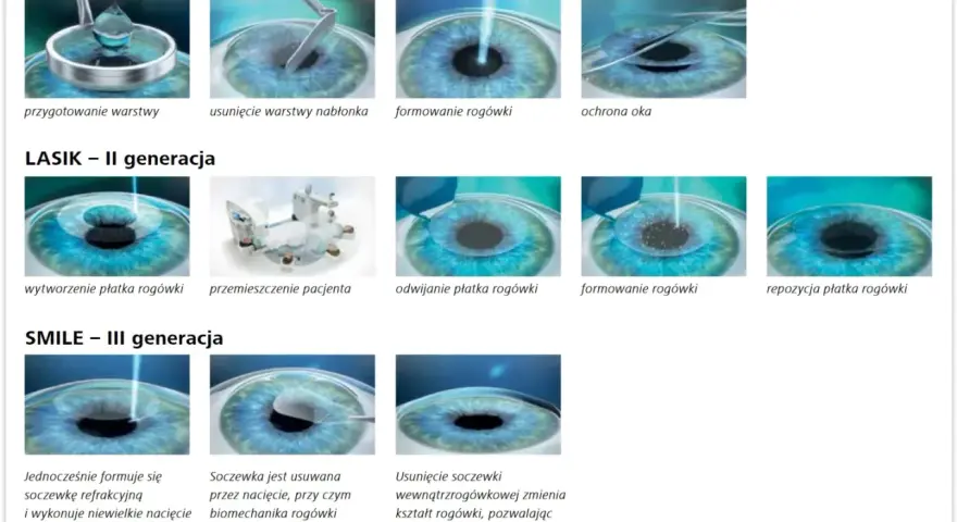 Ilustracje pokazują metody korekcji wzroku laserem: PRK, LASIK, SMILE. Nie ma tu informacji o laserze na kręgosłup lędźwiowy przeciwwskazania.